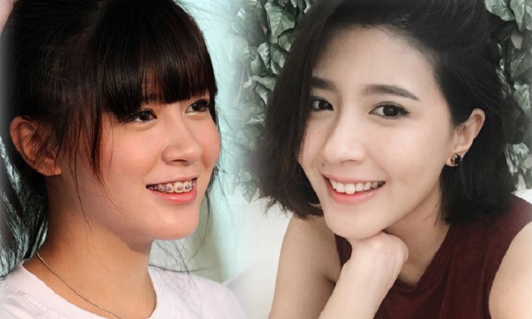 5 hình ảnh chứng minh: Ai rồi cũng sẽ khác, nhất là sau khi họ niềng răng